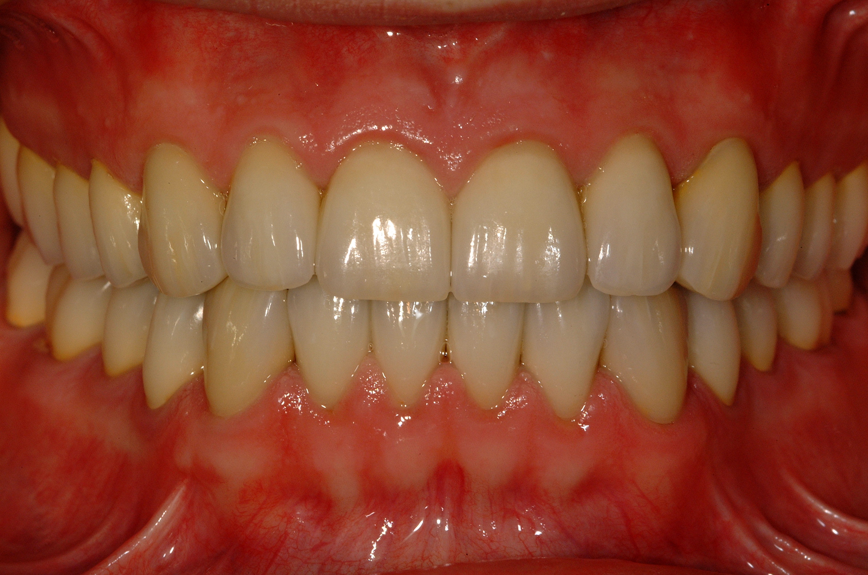 After Full Mouth Rehabilitation